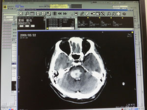 CT images of brain stem bleeding when he fell. Brainstem middle. Portion of the white color bleeding. Was a very serious condition.